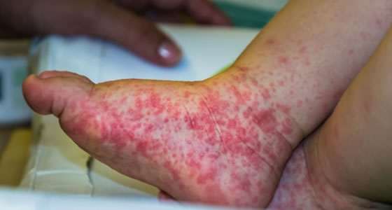 Doença mão-pé-boca