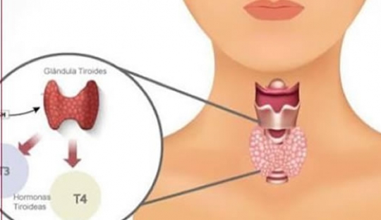 Hipotireoidismo – Tireoidite de Hashimoto